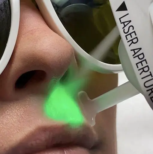 Green laser skin treatment on upper lip
